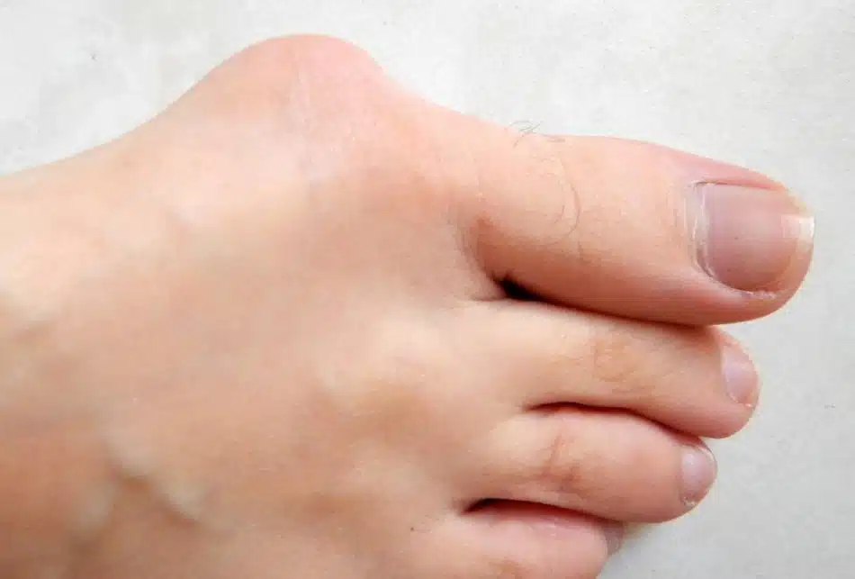 hallux rigidus